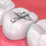 Những ưu điểm nổi bật của thực hiện trám răng bằng Amalgam