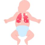 Trẻ sơ sinh viêm phổi: Nhận biết sớm để điều trị kịp thời