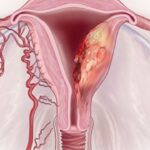 Ung thư nội mạc tử cung và những thông tin quan trọng cần nhớ