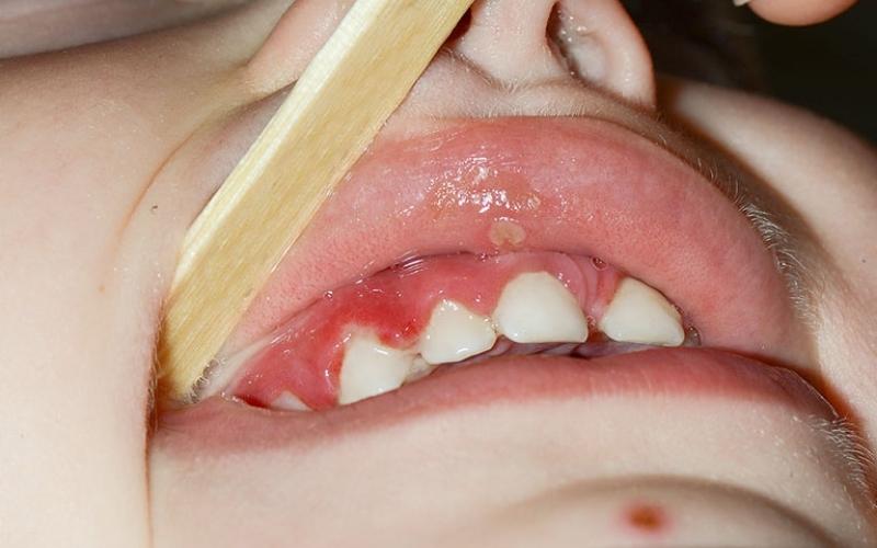 Chăm sóc viêm lợi trùm ở trẻ em