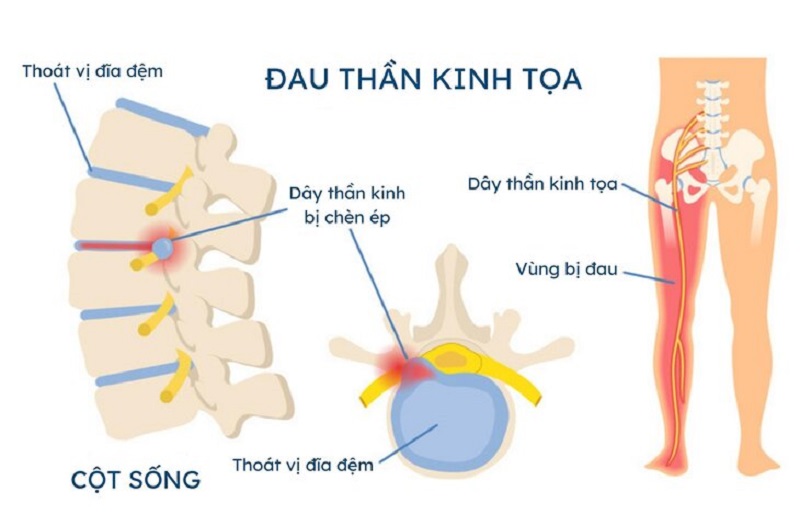 nam ro thong tin ve thuoc dac tri dau day than kinh toa 2