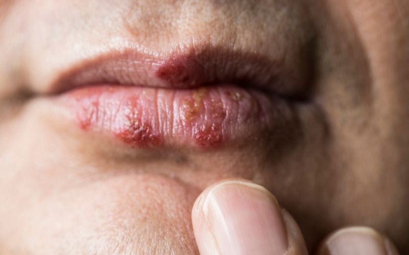 Herpes sinh dục là một trong những bệnh lây qua đường tình dục nguy hiểm.