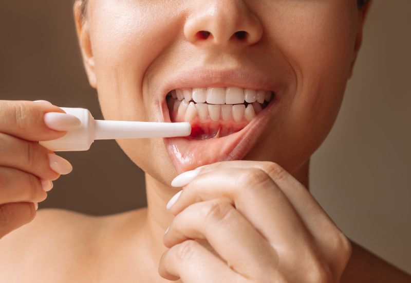 Có nhiều thuốc bạn có thể bôi để đẩy nhanh tốc độ hồi phục nhiệt miệng. Các thuốc bôi nhiệt miệng thường có tác dụng giảm đau, khử trùng.