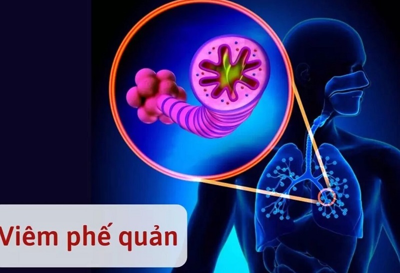 4. Phương Pháp Chẩn Đoán Viêm Phế Quản Cấp J20