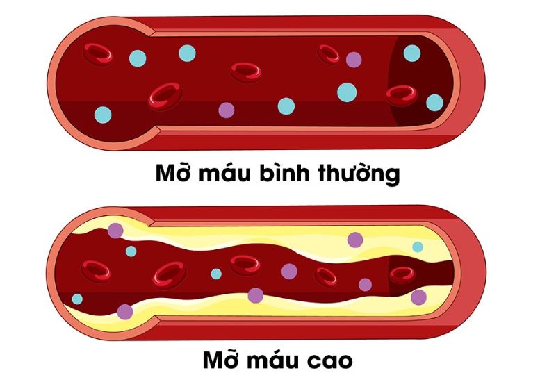 Lipanthyl 200mg dieu tri mo mau nhu the nao