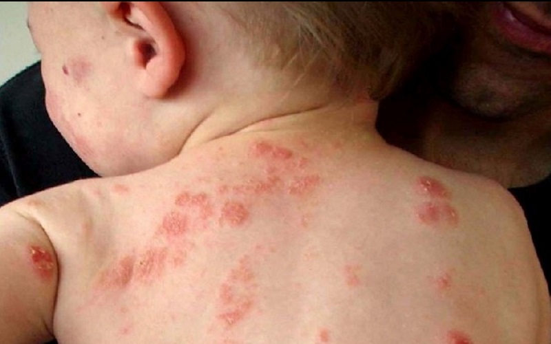 Nhiễm trùng da điều trị bằng phương pháp nào?
