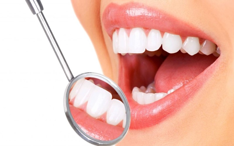 Cao răng được làm sạch