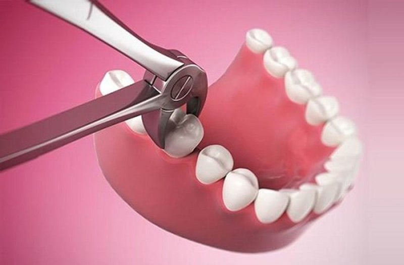 Nên nhổ răng vào lúc nào phù hợp