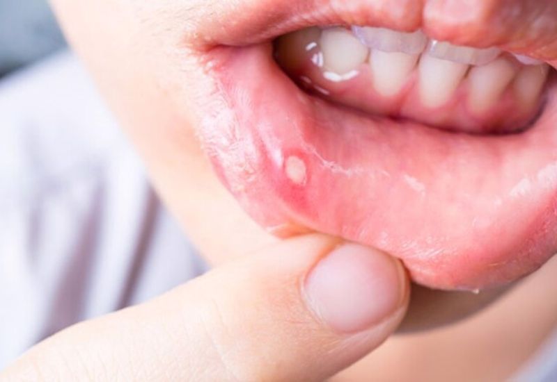 Nên làm gì để phòng tránh nhiệt miệng