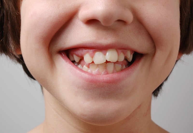 Nguy cơ tiềm ẩn của viêm lợi ở trẻ sơ sinh