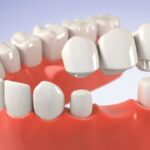 Phương pháp bắc cầu răng sứ: Lợi ích và bảng giá trồng răng