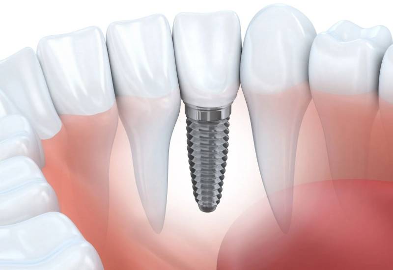 chi phí trồng răng implant bao nhiêu