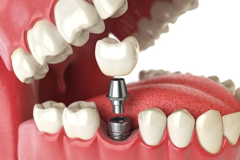 chi phí trồng răng implant nhiêu tiền