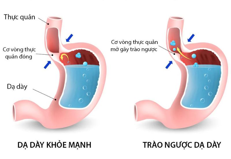 kho nuot nuoc bot nguyen nhan do dau