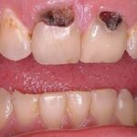 Răng cửa sâu: Nguyên nhân, triệu chứng, giải pháp