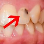 Giải pháp toàn diện giúp ngăn ngừa sâu răng viêm lợi hiệu quả