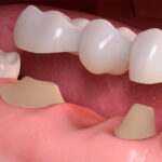 Trồng răng sứ – Giải pháp để hàm răng hoàn hảo