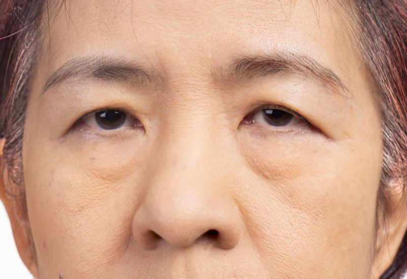 Sụp mí mắt là tình trạng mí mắt trên sa xuống thấp hơn vị trí bình thường, che khuất một phần con ngươi, gây cản trở tầm nhìn.