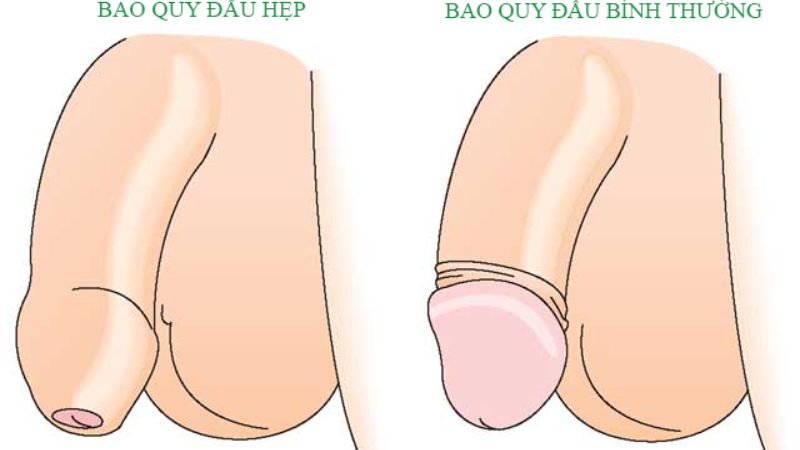 hinh anh hep bao quy dau o nguoi lon