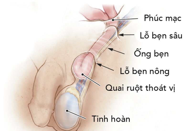 mo thoat vi ben