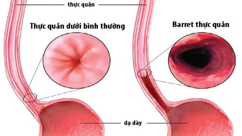 nguyen nhan gay kho nuot khi an