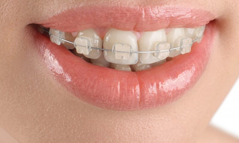 niềng răng sứ thẩm mỹ như thế nào