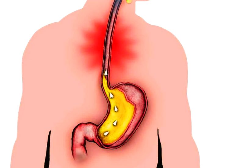 Vì sao bị ợ nóng thường xuyên và giải pháp cải thiện