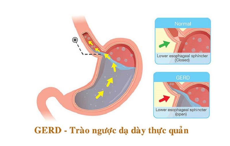 Biểu hiện nuốt vướng và vai trò chẩn đoán của HRM