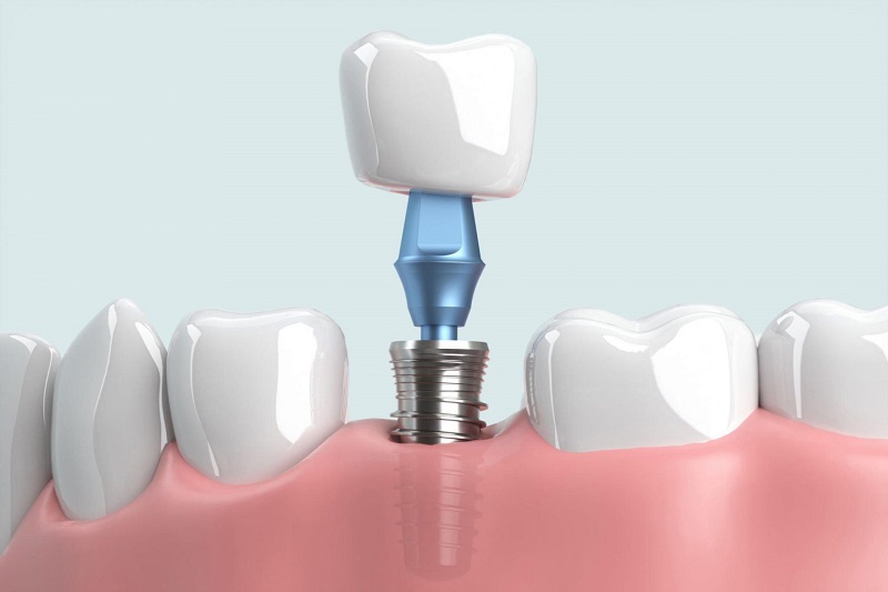 Không phải tất cả mọi người đều có thể cấy trụ implant