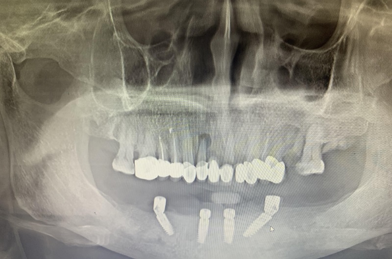 Trước khi trồng răng, người bệnh được xét nghiệm hình ảnh, đánh giá sức khỏe răng miệng