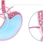 Lý giải nguyên nhân dịch dạ dày trào ngược vào thực quản