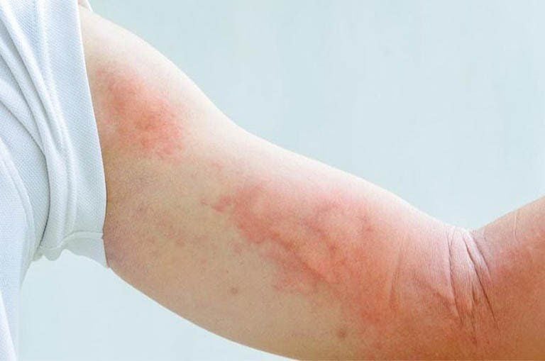 Mẩn ngứa sau tiêm vacxin là hiện tượng thường gặp