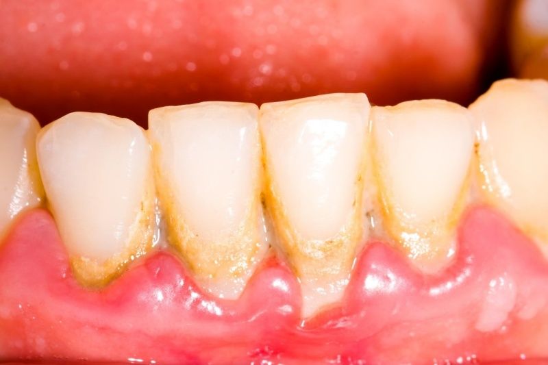 Cao răng hình thành từ mảng bám không được làm sạch kỹ càng, lâu ngày tích tụ và cứng lại dưới tác động của nước bọt.