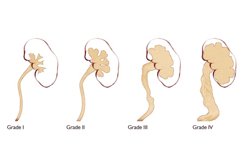 Giãn đài bể thận độ 1 có thể tự khỏi không?