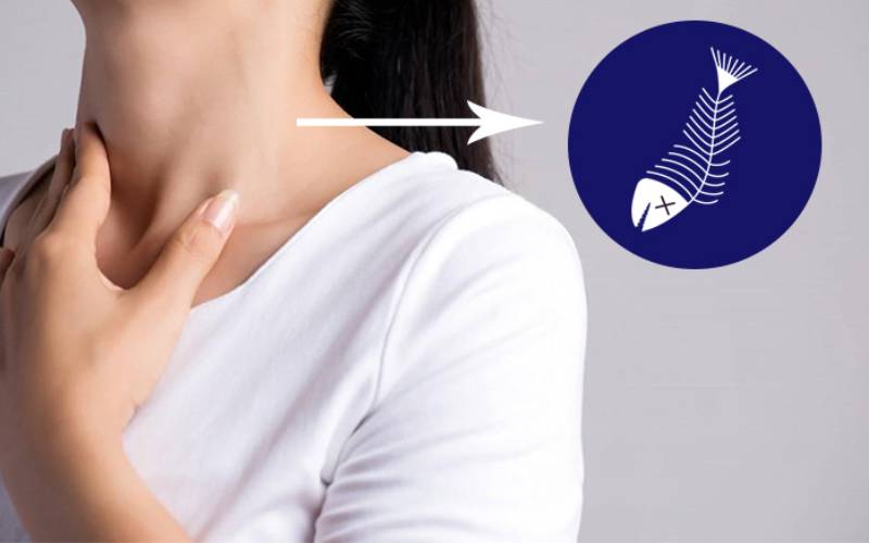 Xương cá dính cổ họng nguy hiểm