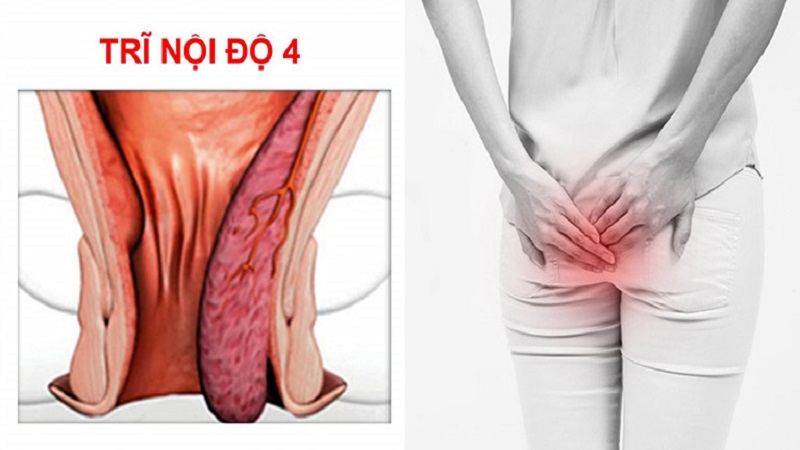 Trĩ nội độ 4 gây đau đớn nhức nhối