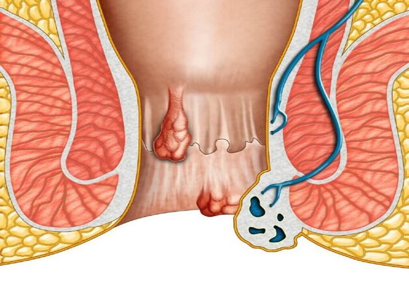 Dấu hiệu nhận biết bệnh trĩ