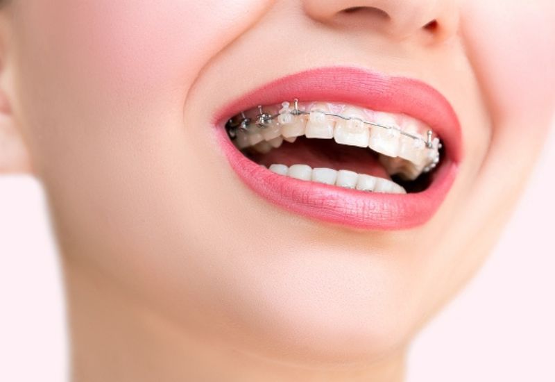 Niềng fun88 chính thức là phương pháp thẩm mỹ phổ biến, giúp cải thiện nụ cười và tăng sự tự tin trong cuộc sống.
