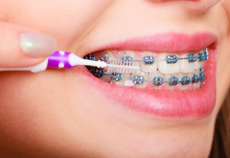 Sau khi niềng fun88 chính thức, việc vệ sinh răng miệng đúng cách là vô cùng quan trọng.