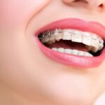 Những sai lầm cần tránh khi niềng răng vẩu để đạt kết quả tốt nhất