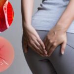 Trĩ nội kéo dài gây ra biến chứng gì – Những nguy cơ bạn không thể bỏ qua