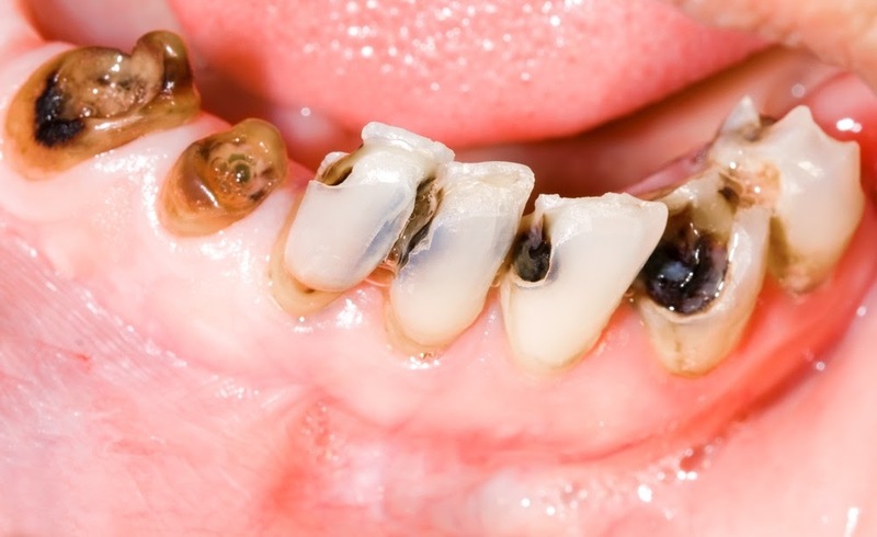 bệnh lý sâu răng biểu hiện thế nào