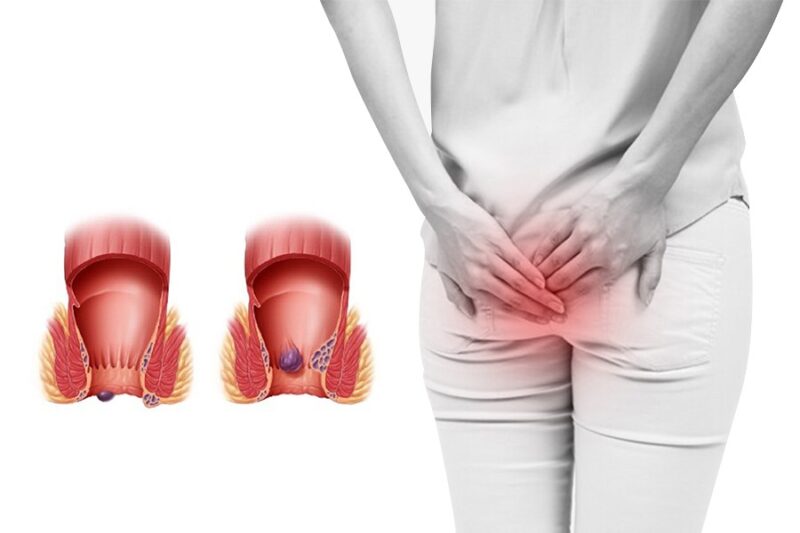 Người bệnh trĩ cần lưu ý một số vấn đề khi ăn khoai lang