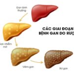 Viêm gan nhiễm mỡ: Cơ chế sinh bệnh và cách phòng ngừa