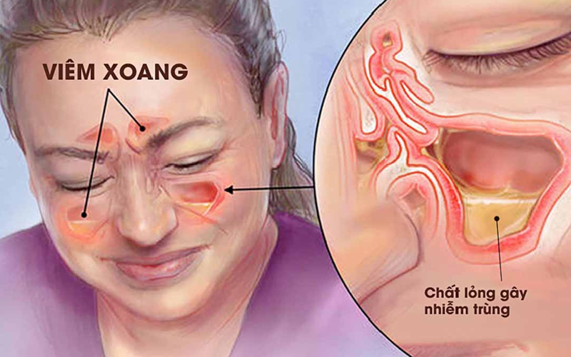 Thế nào là Bệnh viêm xoang mũi