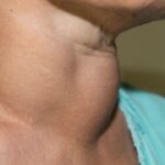 Phân biệt cường giáp và bướu cổ, cách kiểm soát