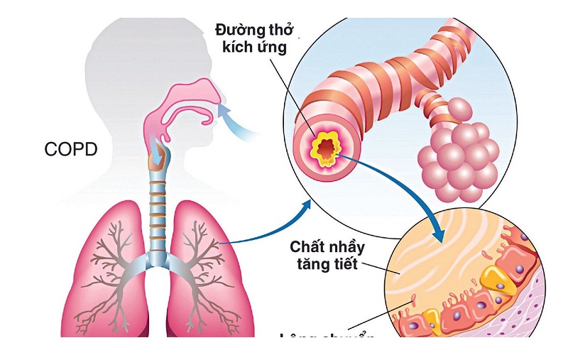 Viêm phế quản cấp