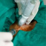 Điều trị u tuyến giáp lành tính không mổ không nằm viện