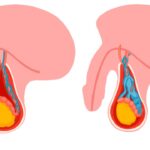 Giãn tĩnh mạch thừng tinh: Bệnh lý nam khoa và điều cần biết