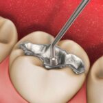 7 Lợi ích không ngờ của việc hàn răng nứt đúng thời điểm